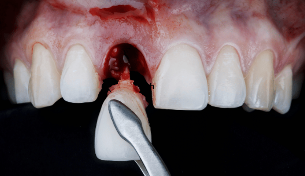 After a Tooth Extraction: A Simple Recovery Plan