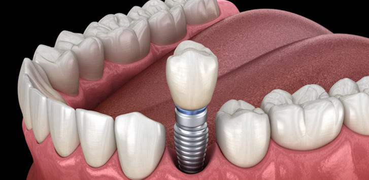 Why Dental Implants Are An Investment In Long Term Oral Health