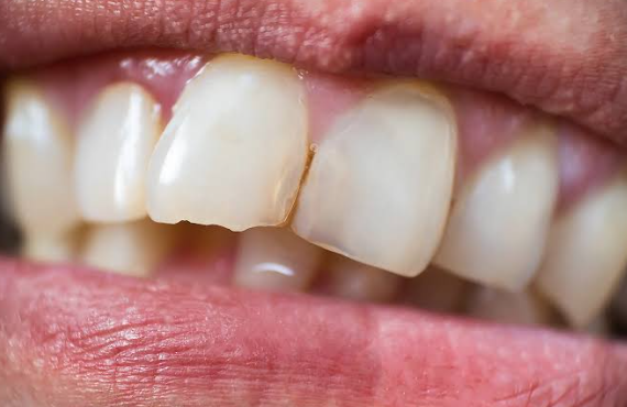 7 Details That Influence Whether A Front Tooth Repair Looks Seamless