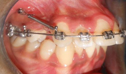 5 Factors That Influence How Teeth Respond To Orthodontic Force